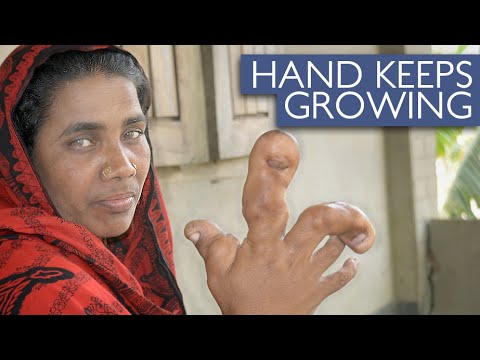 شاهد سيدة تعاني من مرض يجعل كف يدها في حجم كرة قدم