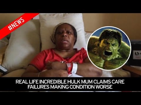 بالفيديو مرض نادر يحول امرأة إلى الرجل الأخضر