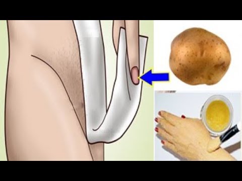 شاهد البطاطس للتخلص الفوري من شعر العانة