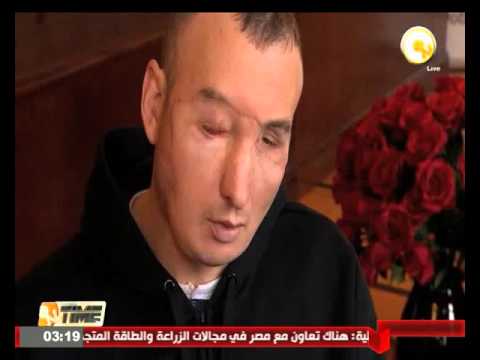 شاهد بولندا تؤكد نجاح أسرع عملية زراعة وجه كامل
