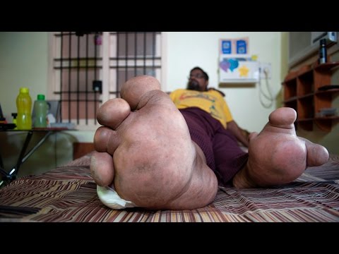 بالفيديو حالة نادرة لقدم رجل وزنها 100 كيلو جرام